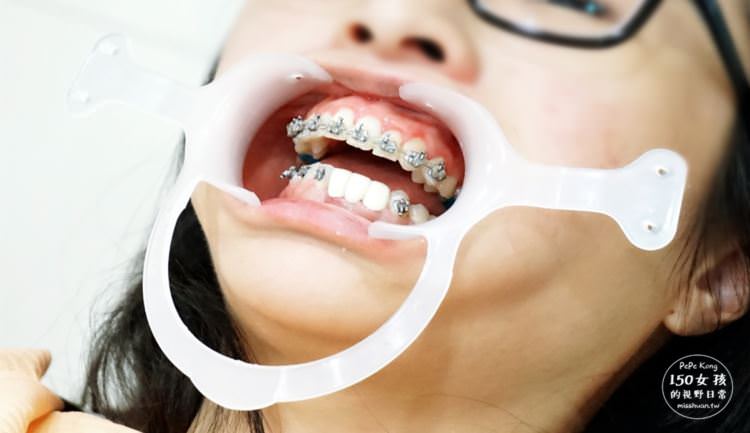 新竹竹北牙醫 真美牙醫診所 舒眠植牙中心 牙橋手術開始 暫時假牙保護 無痛打針好放鬆 超有效率的牙套整牙 一口整齊好牙超開心