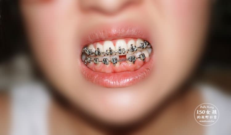 新竹竹北牙醫 真美牙醫診所 舒眠植牙中心 牙橋手術開始 暫時假牙保護 無痛打針好放鬆 超有效率的牙套整牙 一口整齊好牙超開心