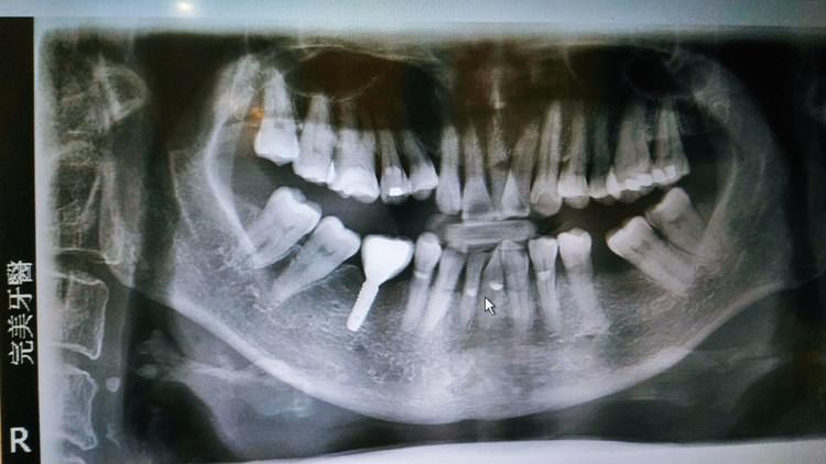 完美牙醫診所 植牙醫學中心 媽咪植牙初體驗 原來植牙根本沒有想像中恐怖 無痛植牙好開心 交給專業就是安心啦