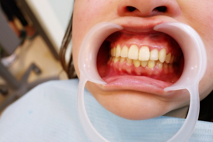 新竹牙醫推薦 日光翡麗 牙醫診所 雷射美白初體驗 只要一小時就輕鬆變漂漂 馬瑞宏醫師好專業